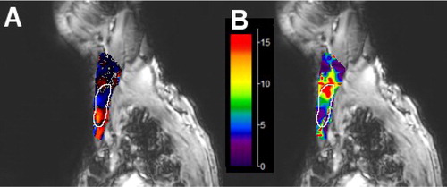 Figure 2. Phase image (A) and elastic shear modulus (µ=E/3) image in kPa (B) in the region of interest of SCM represented by white border line.