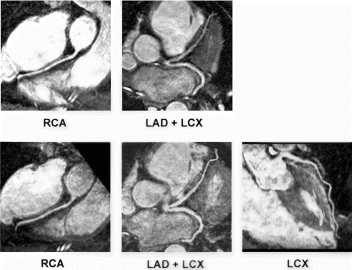 Figure 1. Locally adapted reformatted images obtained with the thin-slab approach (top) and the full-coverage approach (bottom). The full length of the LCX may only be appreciated in the image based on a coronal reformat data set of the full-coverage scan (bottom right).