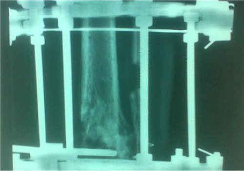 Fig. 7 Postoperative anteroposterior lower extremity radiograph at 6 months after the Ilizarov external fixation application.