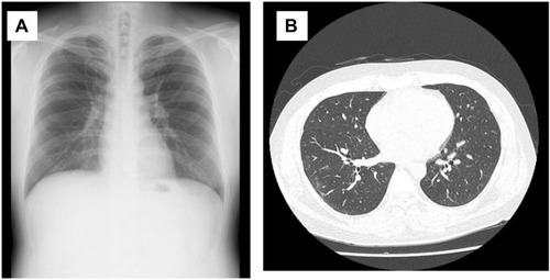 Figure 1 The chest X-ray (A) and computed tomography (CT) (B) findings of a 39-year-old COVID-19 patient. Almost no abnormal findings, including ground glass opacities (GGOs), are seen.