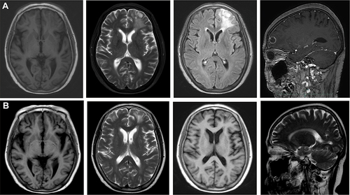 Figure 4 Brain MRI images of the patient. (A) Brain MRI on January 25, 2022. (B) Brain MRI on April 16, 2022.