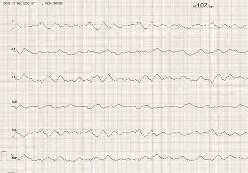 Figure 1. Electrocardiogram after yew poisoning showing an irregular arrhythmia at a rate of 107/min with bizarre QRS prolongation.