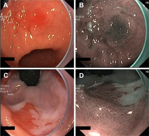Figure 3 Example images of areas of suspected early cancers of the gastric antrum (A and B) and cardia (C and D), imaged using standard WLE (A and C) and NBI (B and D) to demonstrate the contrast enhancement provided by NBI.
