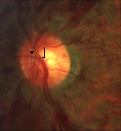 Figure 3 In the left eye, the bifurcation of the central retinal artery sits atop a segment of the central retinal vein at the site of obstruction (bracket).