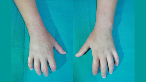 Figure 1 Hands’ photograph of the 54-year-old woman shows thickening of the skin, flexion contractures of the interphalangeal joints and oedema.