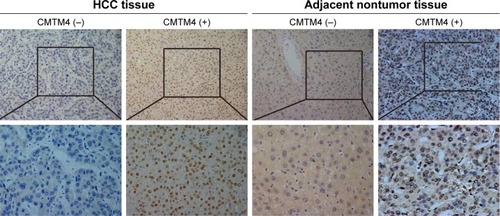 Figure 1 The expression of CMTM4 in HCC tissues and adjacent nontumor tissues by immunohistochemistry (magnification, ×200).