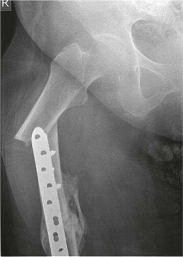 Figure 2. Patient 5. Atypical peri-implant fracture at the proximal end of a plate used to fix a midshaft fracture of the femur.