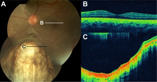 Figure 57 (A) Color fundus photograph of a retinochoroidal coloboma. (B) Normal foveal contour. (C) Cirrus™ optical coherence tomography shows the typical features of retinochoroidal coloboma with the lack of retinal and choroidal tissues, and light backscatter.