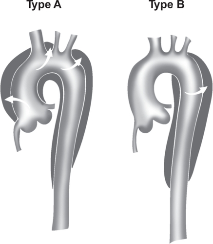 Figure 3B Stanford classification of aortic dissection. Stanford type A includes dissections that involve the ascending aorta, arch, and descending thoracic aorta. Stanford type B includes dissections that originate in the descending (and thoracoabdominal) aorta, regardless of any retrograde involvement of the arch.