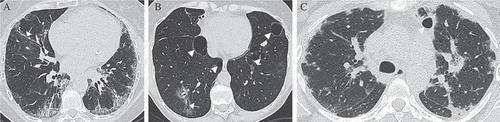 Figure 3. Types of interstitial pneumonia on high-resolution computed tomography (HRCT). (A) A primary Sjögren’s syndrome (pSS) patient with fibrotic non-specific interstitial pneumonia. HRCT shows reticular abnormalities with traction bronchiolectasis (white arrow), ground-glass opacity and lymphadenopathy. (B) A pSS patient with lymphocytic interstitial pneumonia. HRCT shows multiple air cysts (white arrowheads), ground-glass opacity, and traction bronchiolectasis (white arrow). (C) A pSS patient with organizing pneumonia. HRCT shows bilateral patchy consolidations with peripheral and peribronchial predominance and an air cyst (white arrowhead).