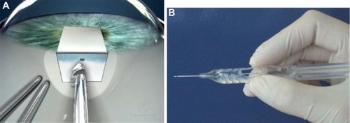 Figure 1 The EX-PRESS Glaucoma Filtration Device is placed under a partial-thickness scleral flap through a 25-gauge needle tract at the limbus.