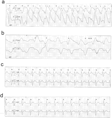 Figure 4. Sequential electrocardiograms 2 ½ h (a) 3 h (b), 18 h (c), and 22 h (d) after ingestion of Taxus baccata.