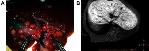Figure 1 PVTT in VX2 rabbits. (A) Portal vein tumor thrombus successfully grown. (B) MRI showed equisignal in portal vein, which indicated PVTT production(arrow).