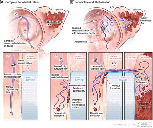 Figure 3. PDL as a precursor to DRT: Putative mechanisms of impaired endothelialization following implantation. (a) Following endovascular LAAO, over time, the LAAO device should ideally be covered by healthy endothelium to prevent thrombogenicity and resultant PDL. (a1) The nature of LA flow (high-velocity laminar vs. low-velocity turbulent) may impact the efficacy of endothelialization. (b) In the context of (b1) low-velocity turbulent flow in the LA, impaired endothelialization may result thereby exposing the thrombogenic surface of the LAAO device to the coagulation system at a time when patients may be discontinuing anticoagulation therapy resulting in DRT and risk of cardioembolism. In the context of PDL (b2), persistent flow in and out of the LAA around the device may also lead to impaired endothelialization and PDT but also delay thrombosis of the LAA and allow for the embolization of LAA thrombi