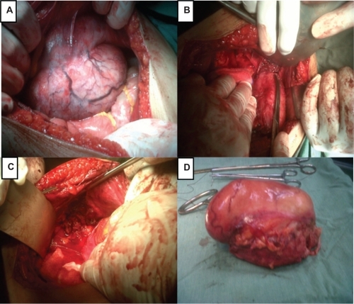 Figure 3 A) A picture showing the tumor in the inner aspect of the abdominal wall. B) The picture shows the margin of the sharp dissection. C) The tumor has been completely removed with a safe margin. D) The whole tumor after removal.