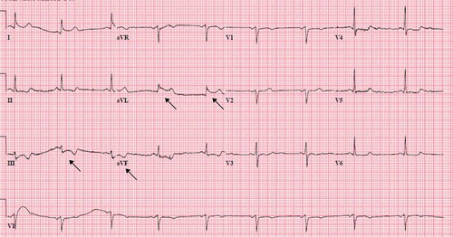 Figure 3. EKG showing sinus bradycardia, ST elevation in lateral leads (I, aVL), ST depression in inferior leads (III, aVF)