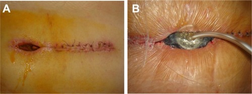 Figure 1 Pre-VAC spinal wound (A); after application of the VAC device (B).
