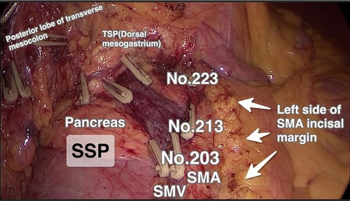 Figure 2 Central lymph node group (N3; 203, 213, and 223) excision and the left side of SMA incisal margin in the laparoscopic CME group, for hepatic flexure colon cancer.Abbreviations: TSP, third surgical plane; SMA, superior mesenteric artery; SMV, superior mesenteric vein; SSP, second surgical plane; CME, complete mesocolic excision.