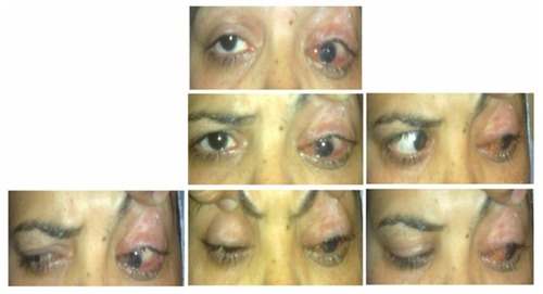 Figure 7 Postoperative pictures of Case 5 (1 month after single-stage adjustable strabismus surgery) with maximum IR recession showing limited left-eye elevation, under-corrected hypotropia, residual ptosis, and lagophthalmos due to shortened lid.