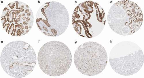 Figure 1. Villin immunostaining in normal tissues. The panels show a strong villin positivity of epithelial cells of the ileum (a), appendix (b), and the gallbladder (c) as well as in proximal tubuli of the kidney where the staining predominates at the luminal membrane (d). A somewhat weaker villin staining occurs in a fraction of epithelial cells of the caput epididymis (e) and at apical membranes of hepatocytes (f). In the pancreas, a strong staining occurs in the epithelium of excretory ducts, while the positivity is less intense at the luminal membranes of acinar cells and the membranes of a fraction of islet cells (g). Villin immunostaining is lacking in urinary bladder urothelium (h).