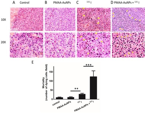 Figure 7 Histology of B16-NIS tumors after treatment with radioiodine combined or not with PMAA-AuNPs nanoparticles. Tumor histology was compared on sections (10× and 20× magnification) of lesions from B16-NIS challenged mice either untreated (A), or treated with PMAA-AuNPs (B), or with 20 MBq 131 I (C), or with PMAA-AuNPs/radioiodine (D). Arrows indicate the presence of pyknotic cells within lesions. (E) Numeration of the dying cells within lesions indicates a significantly increased mortality of the tumour cells in the PMAA-AuNPs/131I treated-lesions compared to all other groups of treatments. **p<0.001, ***p<0.0001.