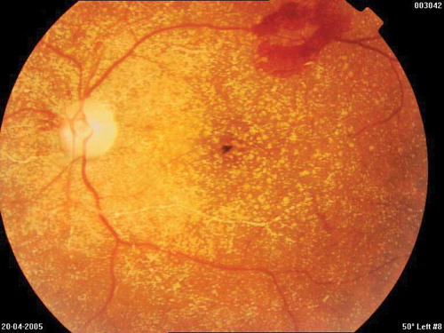 Figure 4. In the fundus examination preretinal, intraretinal, and intravascular diffuse oxalate crystals were detected on both eyes, especially dense in the posterior pole; in the left eye, diffuse soft exudates and a large preretinal hemorrhage on the the upper temporal vessel arch.