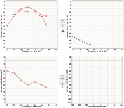 Figure 2. PTAs of the Patient 2 with intracochlear schwannoma in the left and vestibular schwannoma at the level of right CPA. (A) PTA before radiotherapy, (B) PTA 8 months after radiotherapy, showing quick deterioration of the hearing and development of almost complete deafness.