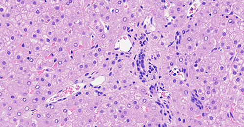 Figure 2 Liver biopsy histology showed the absence of bile ducts in the portal area in children with Alagille syndrome.