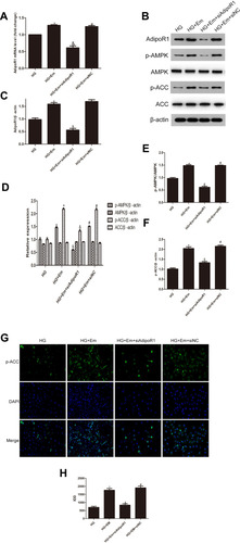 Figure 5 Levels of AdipoR1, p-AMPK, AMPK, p-ACC and ACC in HK-2 cells transfected with siAipoR1 or siNC and treated with empagliflozin under high-glucose conditions. (A) RNA level of AdipoR1. (B) Protein levels of AdipoR1, p-AMPK, AMPK, p-ACC and ACC. (C–F) Histogram of the protein levels of AdipoR1, p-AMPK, AMPK, p-ACC and ACC. (E) Representative images and of immunofluorescence staining for p-ACC. All images are magnified 200x. (F) Cumulative optical density values for p-ACC. *p < 0.05 vs HG; &p < 0.05 vs HG+Em; #p < 0.05 vs HG+Em+siAdipoR1. (G) Representative images and of immunofluorescence staining for p-ACC. All images are magnified 200x. (H) Cumulative optical density values for p-ACC *p < 0.05 vs HG; &p < 0.05 vs HG+Em; #p < 0.05 vs HG+Em+siAdipoR1.