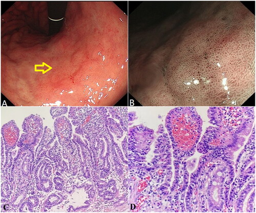 Figure 3. Helicobacter pylori infection-related well-differentiated adenocarcinoma of an Elderly male patient. (A) White light endoscopy image. The yellow arrow indicates the lesion location. (B) NBI image. (C) Well-differentiated adenocarcinoma area (HE, ×200). (D) Well-differentiated adenocarcinoma area (HE, ×400).