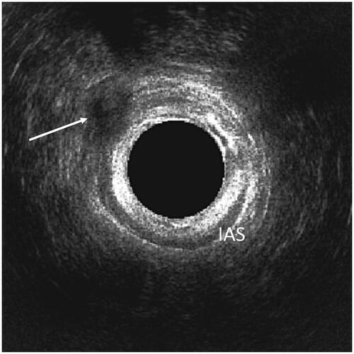 Figure 2. The visible fistula was noted as a hypoechogenic area (white arrow) at 3D EAUS in axial plane after the AFP procedure. IAS: internal anal sphincter.