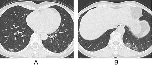 Figure 2 A 52-year-old female patient infected with Omicron strain. (A and B) Axial computed tomography (CT) images show multiple round-like ground-glass opacities (GGOs) distributed peripherally in both lungs.