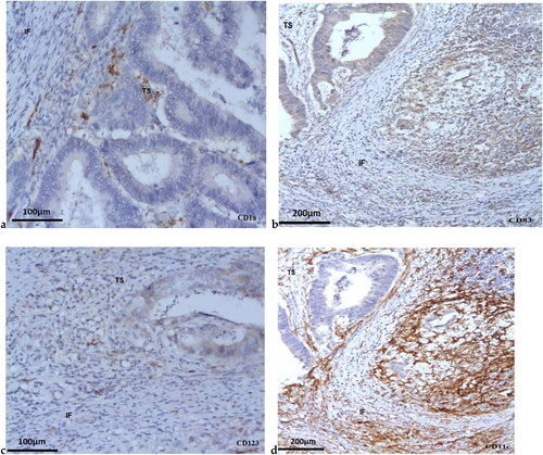 Figure 1. Immunohistochemically labeled DCs in CRC biopsies: CD1a + DCs (200x magnification) (a); CD83+ DCs (200x magnification) (b); CD123+ DCs in CRC (100x magnification) (c); CD11c+ DCs in CRC (100x magnification) (d) (IF: invasive front; TS- Tumor stroma); scale bars = 100 µm (a, c); 200 µm (b, d).