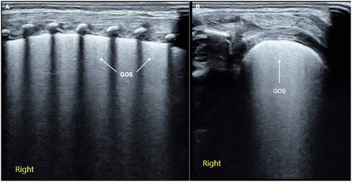 Figure 1. GOS. Perpendicular scanning shows that the pleural line is thickened and blurred, the echogenicity in the near-field is enhanced, and the echogenicity in the far-field is significantly weakened, looking like groundglass opacity (A). Parallel scanning shows that the ground glass-like performance is more obvious in the near field (B). GOS is a characteristic ultrasound finding of grade I RDS.