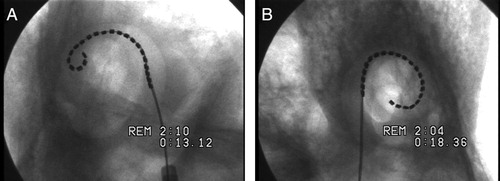 Figure 11. MRA (version 2) showing (A) tip fold-over (B) full insertion only after electrode contacts lateral wall. Images courtesy of CRC Hear, Melbourne, Australia.