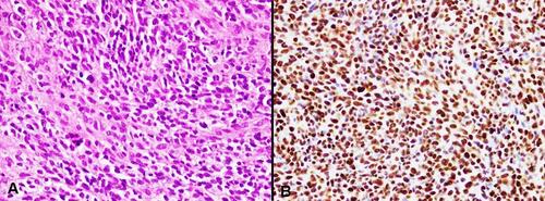 Figure 3 TLE1 staining in malignant melanoma. (A) Malignant melanoma, H&E, 20x. (B) Strong nuclear expression of TLE1 IHC stain in melanoma cells, 20x.