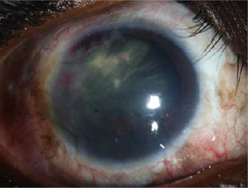 Figure 4 Final slit-lamp biomicroscopy at 8 months revealed the absence of tumor recurrence.