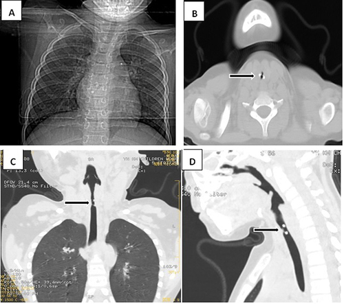 Figure 2 5-year-old girl presented to the clinic with recurrent cough for 5 days. A chest X-ray performed did not show any signs of a foreign body. Further chest CT scan with airway reconstruction revealed a high-density ring-like foreign body within the trachea.