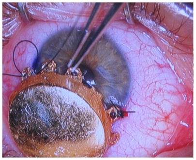 Figure 1 Iodine125 plaque brachytherapy for a patient with an iris melanoma.