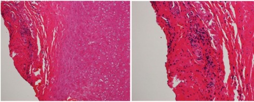Figure 6 Histologic findings of auricular biopsy specimen.
