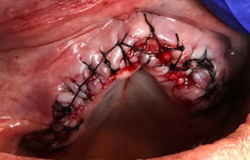 Figure 5 Primary closure with suture.