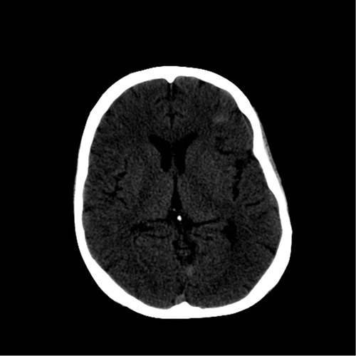 Fig. 1 CT scan Head without Contrast.