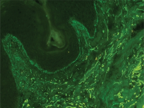 Figure 1 Positive lupus band test at low magnification: immunoglobulin class M deposits at the dermoepidermal junction in sun-protected nonlesional skin in a 26-year-old woman with systemic lupus erythematosus (original magnification: ×100).