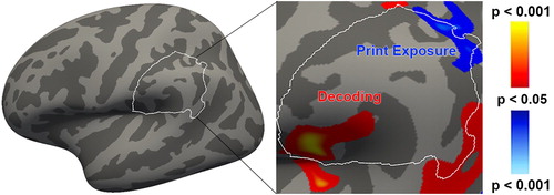 Figure 3. Left supramarginal gyrus: the bounded area is the Desikan-Killiany parcellation of SMG in MNI space. Positive correlations with GMV are depicted on a red-yellow scale, and negative correlations with GMT are depicted on a blue-white scale. Results depicted at an uncorrected vertex-wise threshold of p < 0.05.