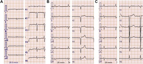 Figure 1 Electrocardiogram of the three presented cases.Notes: In all cases, electrocardiogram showed low voltage in the limb leads. (A) Case 1: low R-wave progression was seen in the chest leads V1 to V3. (B) Case 2: the lack of R-wave was seen in the chest leads V1 to V5. (C) Case 3: low R-wave progression was seen in the chest leads V1 to V4, similar to Case 1. These abnormal R-waves were considered a pseudoinfarct pattern.