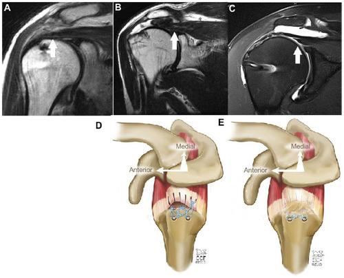 Figure 1 Modes of rotator cuff failure.