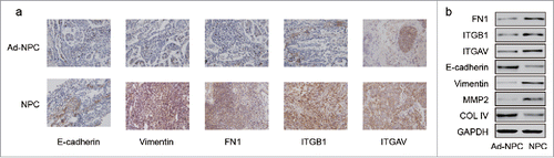 Figure 2. Expression of FN1,ITGB1, ITGAV and related protein expression in NPC tissues and adjacent tissues. (A) Immunohistochemistry was performed and one random paired tissue was shown. More positive area indicates high level of relative protein. (B) The protein level of FN1, ITGB1, ITGAV, E-cadherin, Vimentin, MMP2 and COL IV in NPC tissues and adjacent tissues were measured by western blot. Evaluated EMT process in NPC tissues was confirmed as upregulation of Vimentin and MMP2 and downregulation of E-cadherin and COL IV in adjacent tissues.