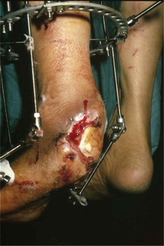 Figure 3. The culture was positive for Staphylococcus aureus and Pseudomonas aeruginosa. After surgical debridement and partial calcanectomy, an Ilizarov external fixator with hinges was applied to decrease the soft-tissue defect in the equinus position.