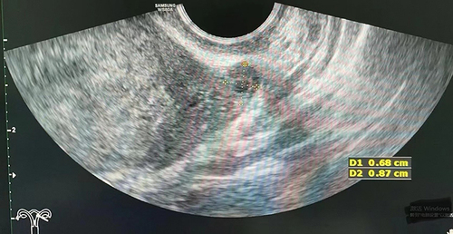 Figure 1 The ultrasound imaging demonstrates a mass at the residual segment of the left fallopian tube (isthmus) consistent with an ectopic pregnancy.