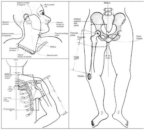 Figure 2 Post surgical radiation fields for node positive patients.Reprinted from Burmeister BH, Mark Smithers B, Burmeister E, et al. A prospective phase II study of adjuvant postoperative radiation therapy following nodal surgery in malignant melanoma–Trans Tasman Radiation Oncology Group (TROG) Study 96.06. Radiother Oncol. 2006;81:136–142. Copyright © 2007, With permission from Elsevier.Citation30